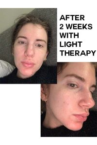 led light therapy for skin