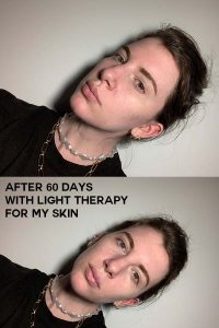 led light therapy for skin results after 60 days