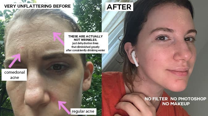 before and after skincare routine to show how to look pretty by improving skin naturally